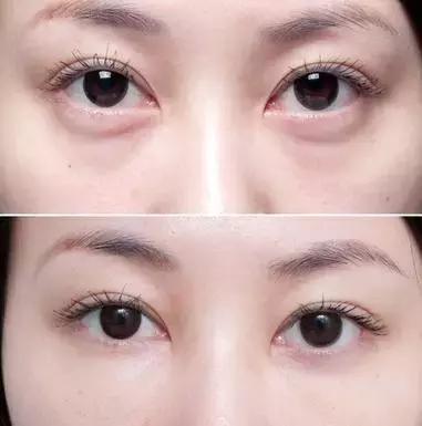 明星注射玻尿酸案例,注射玻尿酸变美