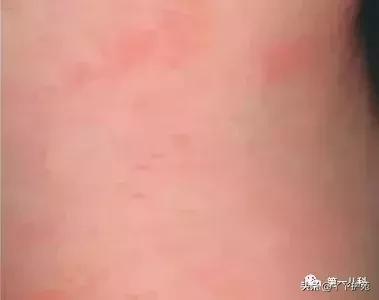 麻疹水痘猩红热手足口病区别,猩红热手足口病怎么治