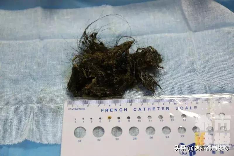西安一女孩吃头发,86岁女童胃里取出2斤头发
