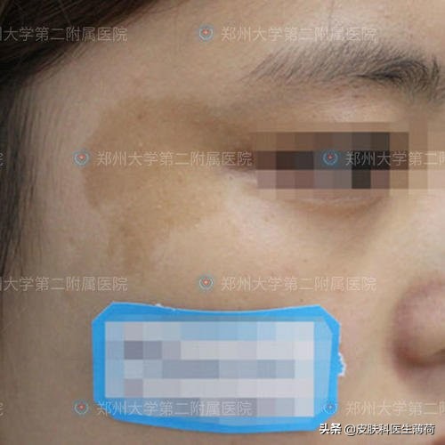 脸上激光了能喝中药吗,激光祛斑可以喝中药吗