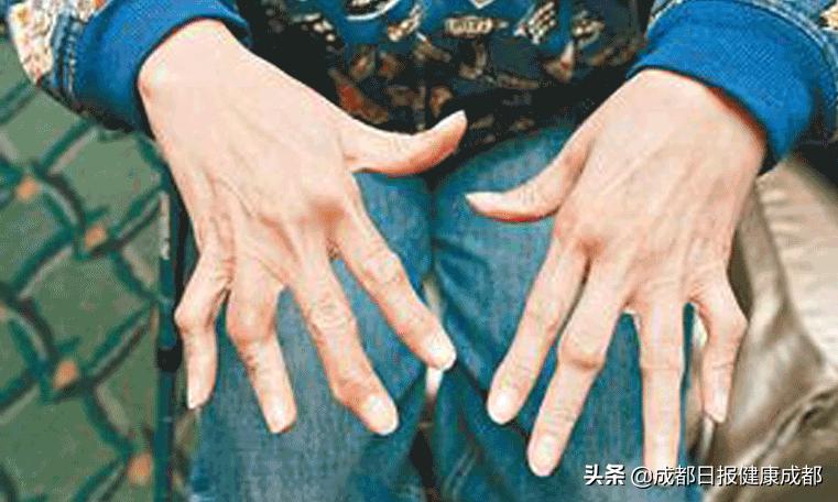 仅两年时间就从腿脚利索变成半残废，这种病要尽早达标治疗才行