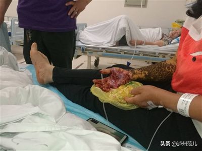 古蔺村民被原矛头蝮蛇咬伤从成都到泸州紧急送药