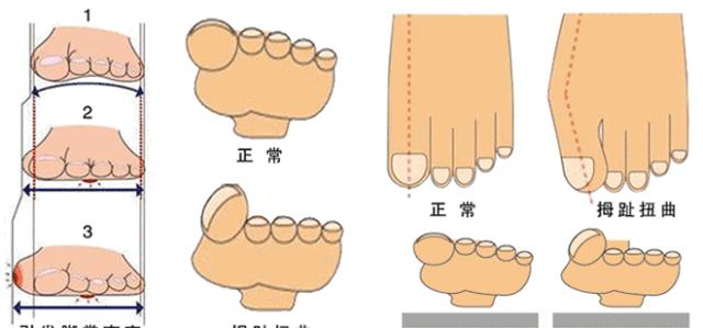 大脚骨会带来哪些危害,割大脚骨的危害