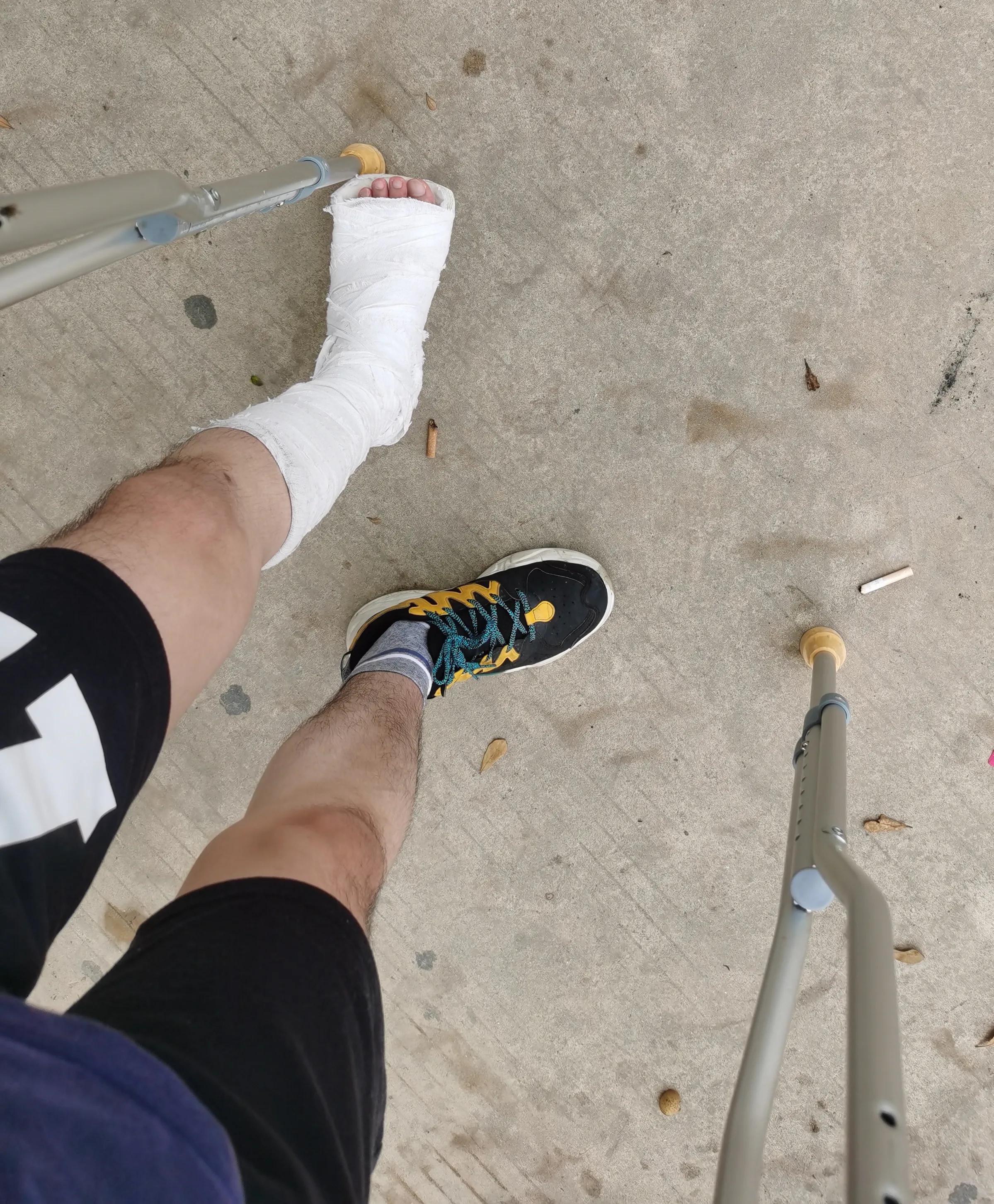 第五跖骨基底部骨折60天能走路吗,第五跖骨基底部骨折60天能脱拐吗