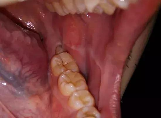 那些不拔智齿的人后来都怎么样了,那些该拔不拔的智齿最后都咋样了