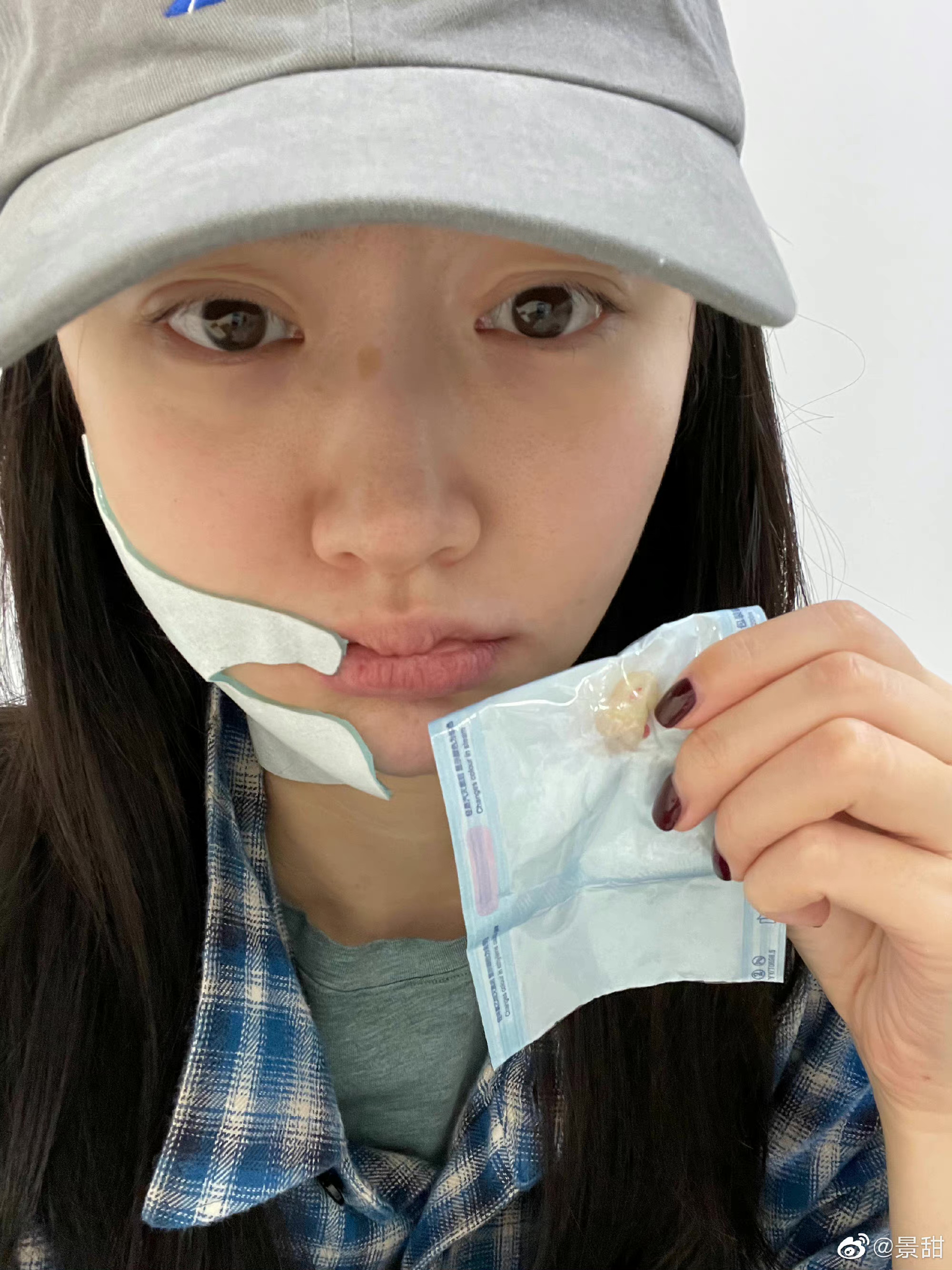 景甜拔牙后自拍照,景甜拔牙后的自拍照