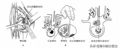 腰间盘突出脚麻腰疼怎么解决,腰间盘突出腰疼的不能动怎么办