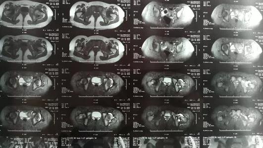 小朋友跳多了晚上就会腿疼,小孩走路跑跳的时候膝盖疼