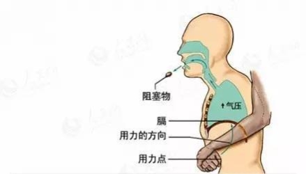 小孩异物卡喉海姆立克急救法,气管异物海姆立克急救法视频下载