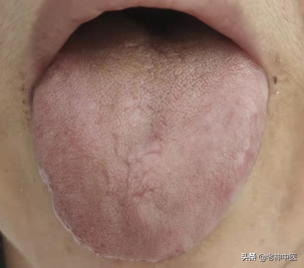 慢性阑尾炎大黄牡丹汤医案,大黄牡丹汤治疗阑尾炎原方