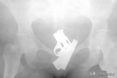 为什么会把异物塞进尿道,为什么会有人往尿道里塞异物