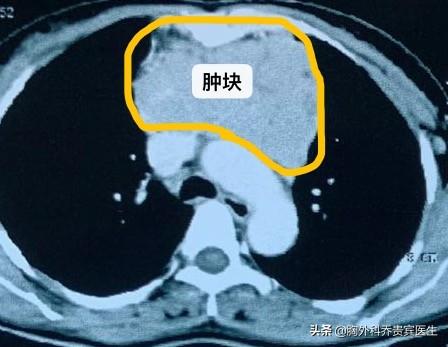 癌症心脏骤停,脑瘤病人什么原因导致心脏骤停