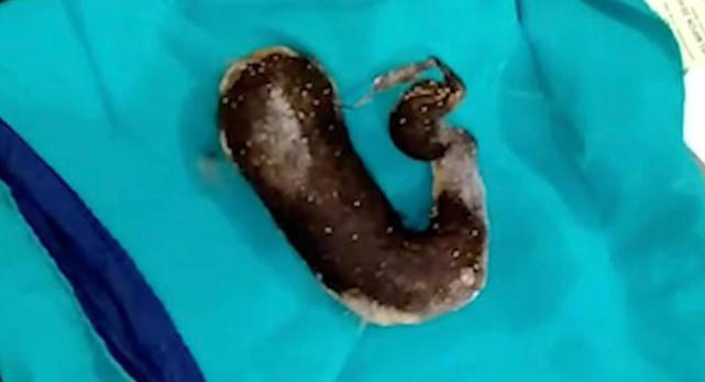 14岁女孩吃头发胃里取出毛球,一女孩胃里取出5斤毛球