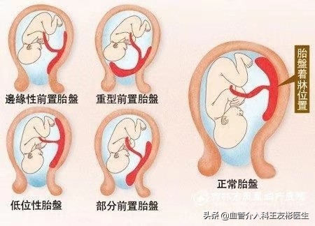 32岁产妇遇上凶险性前置胎盘,凶险性前置胎盘产妇医生全力抢救