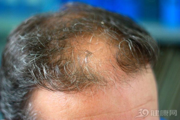 到底哪种产品能治脱发生发,市面上防脱发生发药有用吗