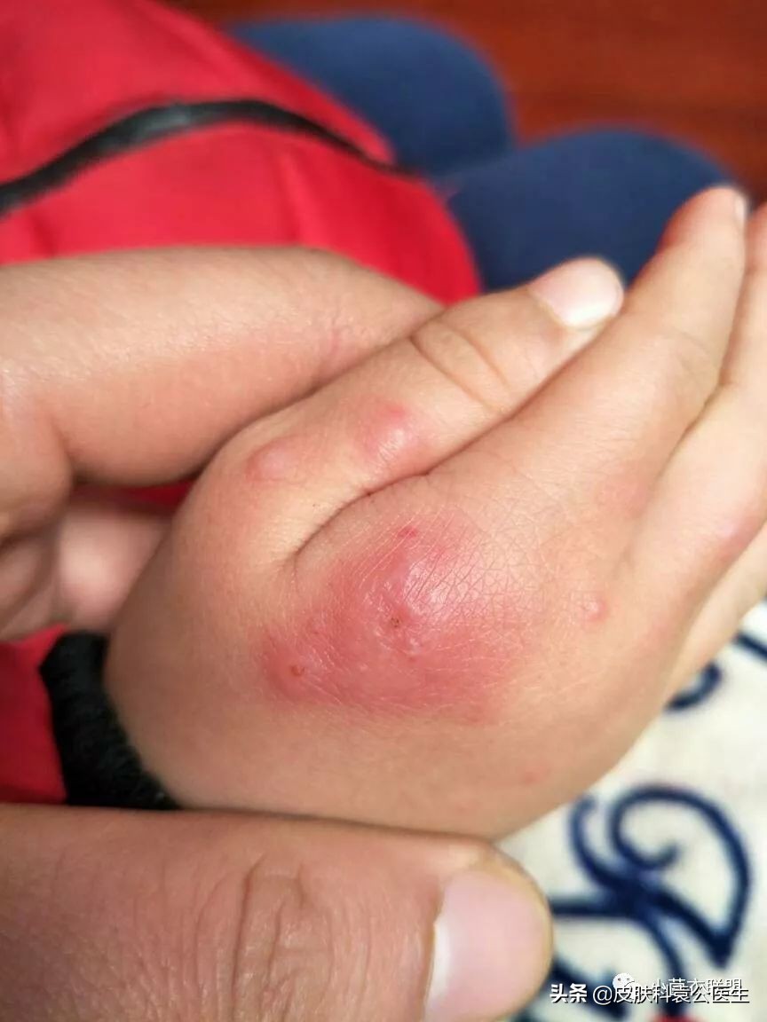 冻疮后期接触水干燥发痒怎么治,冻伤痒痛