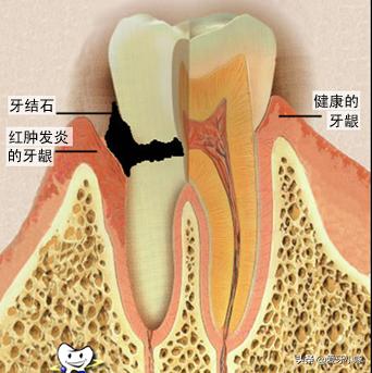 牙周病不能治好的吗,牙周病不治疗后果