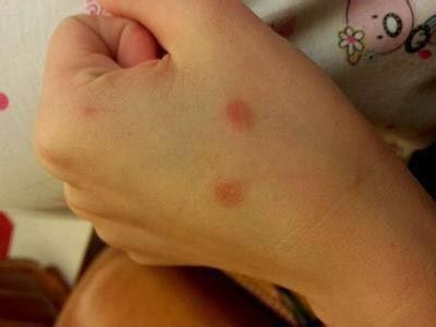 猫癣有这么容易得吗,猫藓没皮屑不长毛