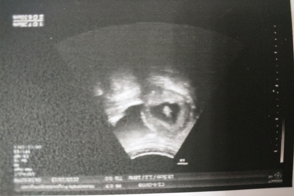 做b超时肚子上涂的是什么,b超检查时肚子上涂的是什么