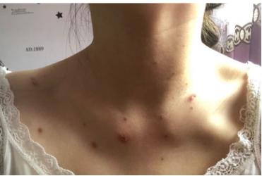 长水痘发烧一般持续几天,起水痘痒得厉害什么方法可以止痒