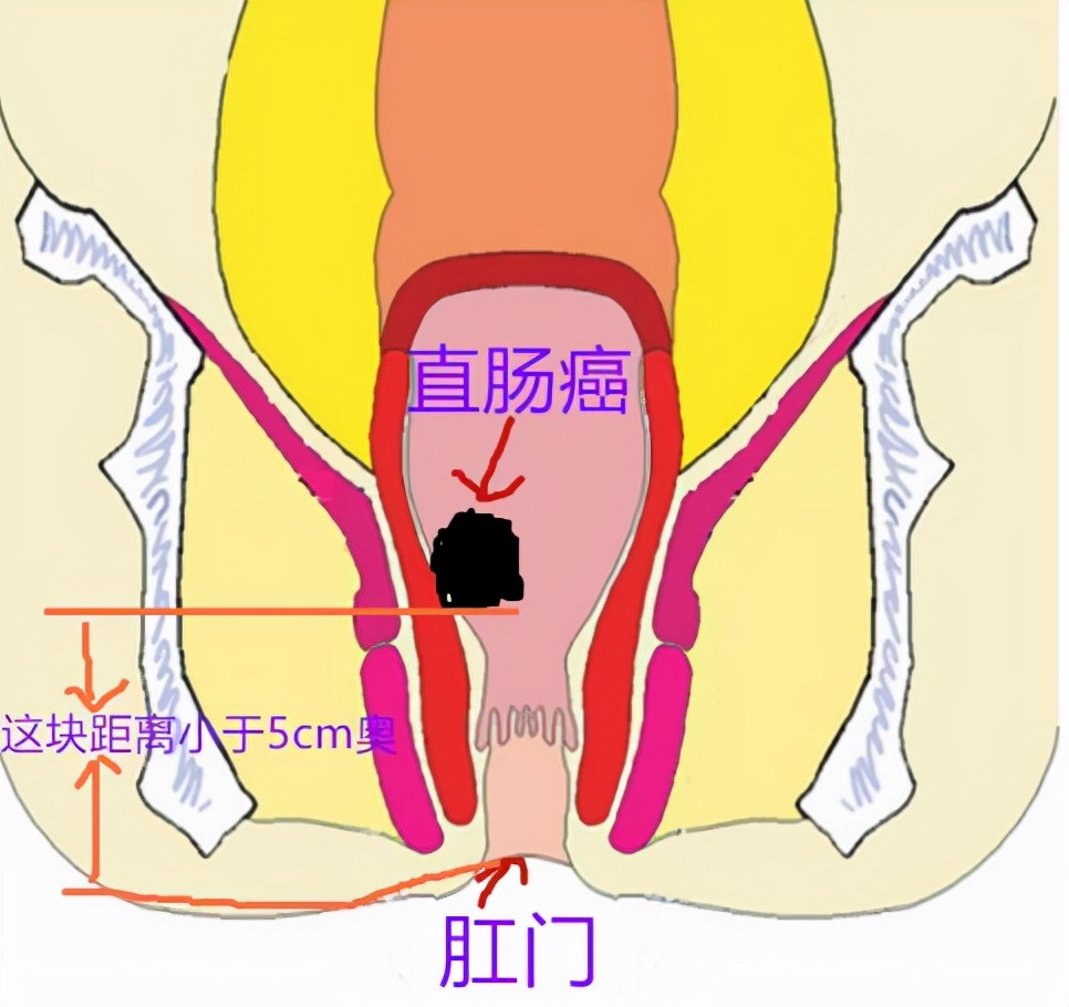 直肠癌术后拉肚子能用蒙脱石散吗,直肠癌频繁上厕所用什么药止泻
