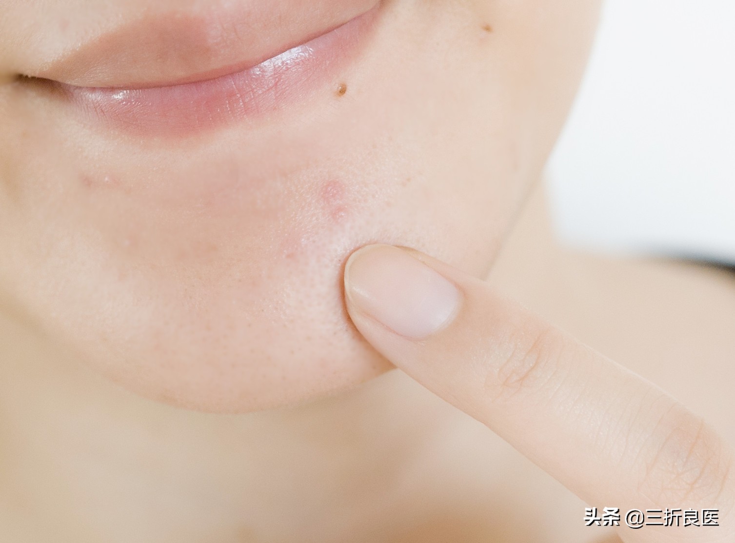 皮肤科教授祛脸上痘印痘坑,皮肤科医生谈痘印痘坑治疗方法