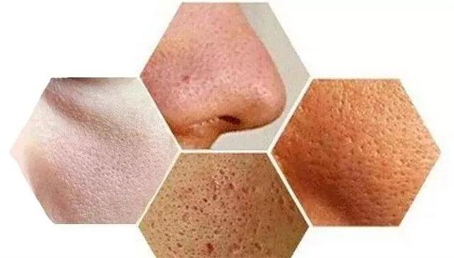 男生毛孔粗大毛孔粗糙怎么办,毛孔粗大怎么办教你一招收缩毛孔
