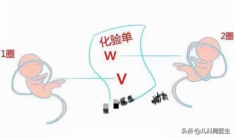 胎儿脐绕颈一周会自己绕回来吗,胎儿绕脐带3圈怎么办