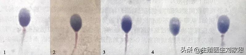 精子畸形率99%胎儿会畸形吗,精子畸形率特别高有什么特效药吗