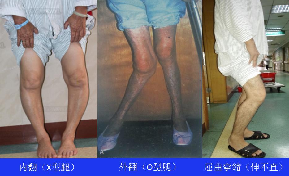 膝关节骨性关节炎症状及治疗,膝关节骨性关节炎诊疗指南下载