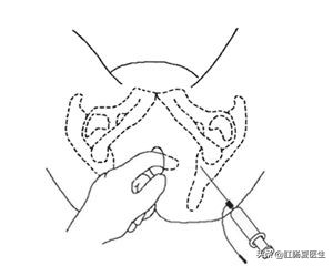 医生，痔疮手术一定会很痛吗？