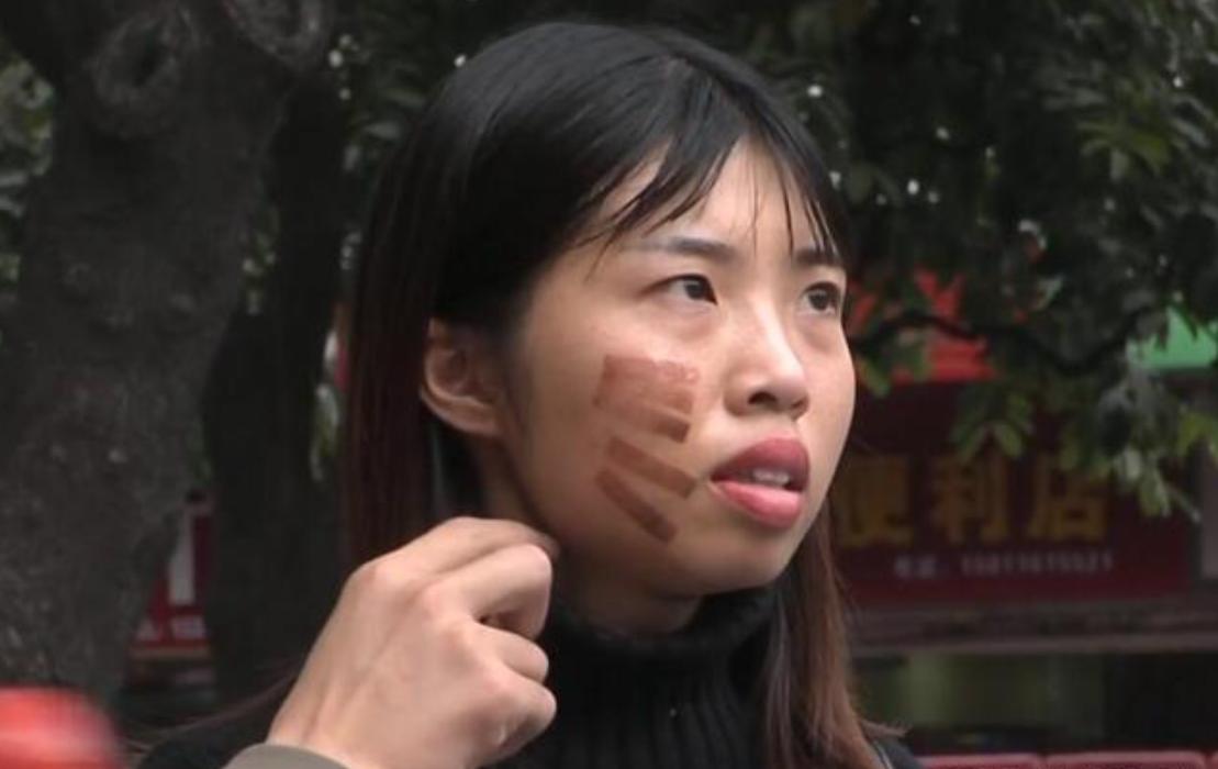 光子嫩肤烫出红印,做光子嫩肤被烫伤会不会留疤