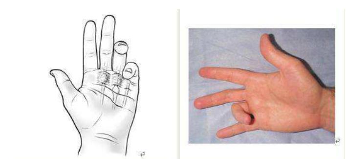 手指腱鞘炎怎么治好得快,手指有腱鞘炎怎么治才能好得快