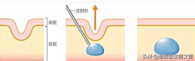 有了泪沟怎么消除,改善显老泪沟试试这3种方法
