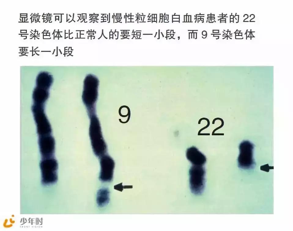 费城染色体p210阳性,费城染色体的由来