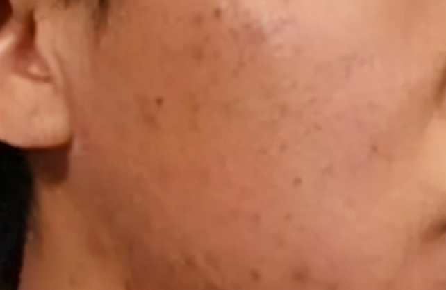 脸上长疮后留下疤痕怎么去除,疮疤怎么彻底消除