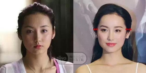 颅顶太低如何自救,颅顶低怎么自救