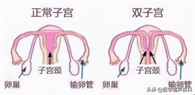 子宫发育异常能怀孕吗,幼稚子宫和子宫发育不良的区别
