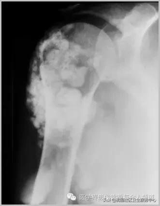 软组织钙化是不是骨化性肌炎,软组织钙化或骨化