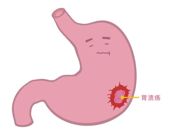 慢性浅表性胃炎是由什么引起来的,慢性浅表性胃炎的症状和如何治疗