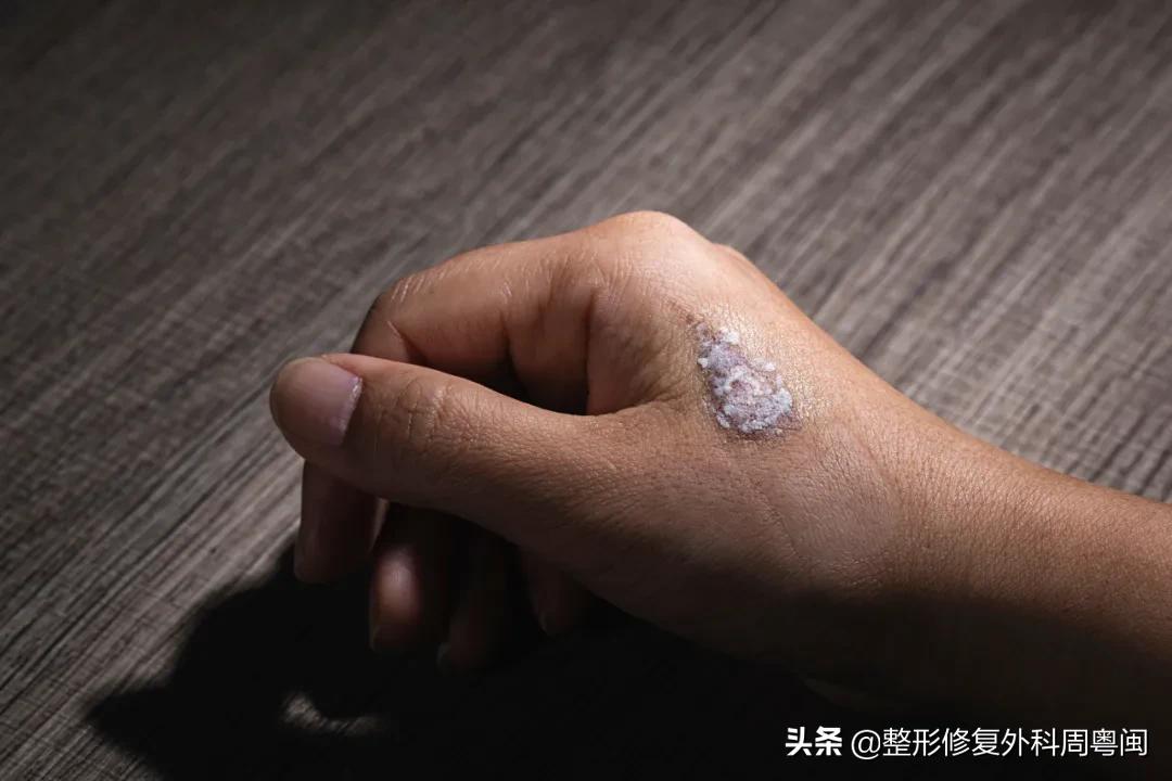 烧烫伤后如何止痒,烧烫伤后的局部处理