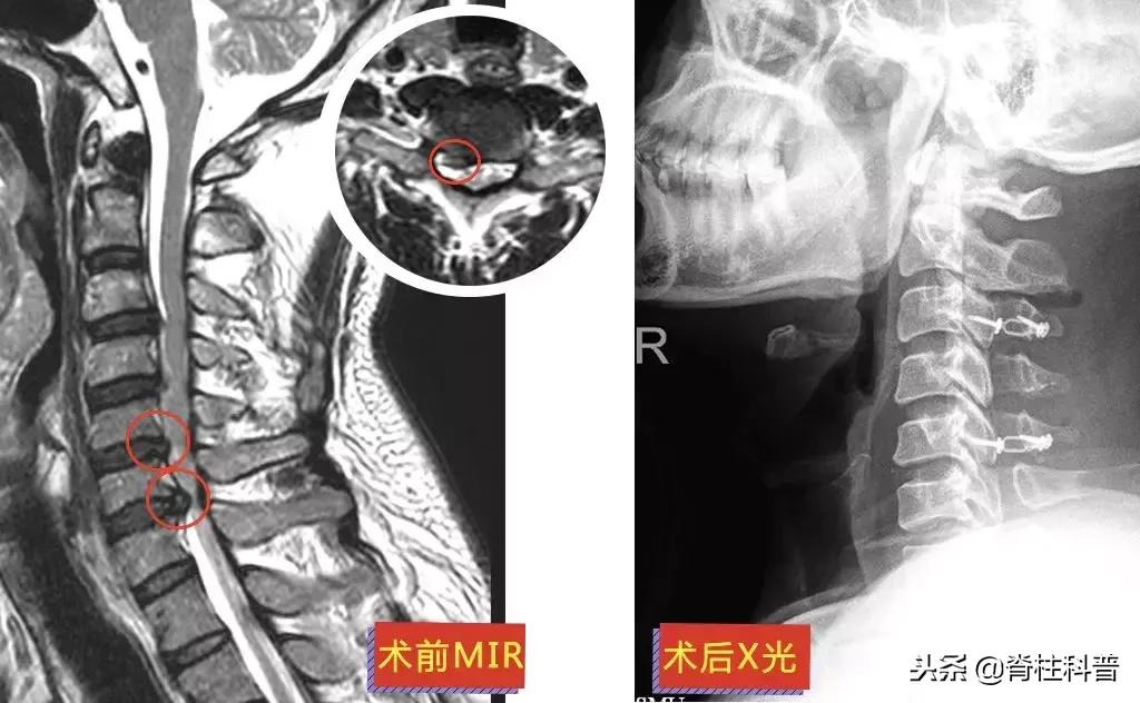 脊髓型颈椎病急刹车,严重颈椎病早期的10大症状