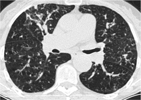 间质性肺疾病看病经验分享,分享肺腺癌临床实验的例子