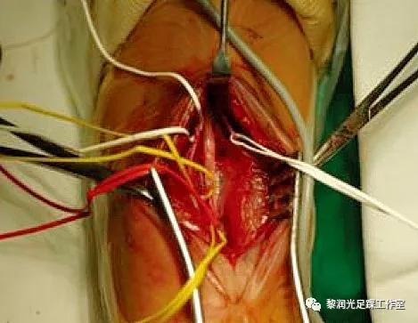 伊里扎洛夫外固定架治疗足部畸形,足部畸形矫正的技巧