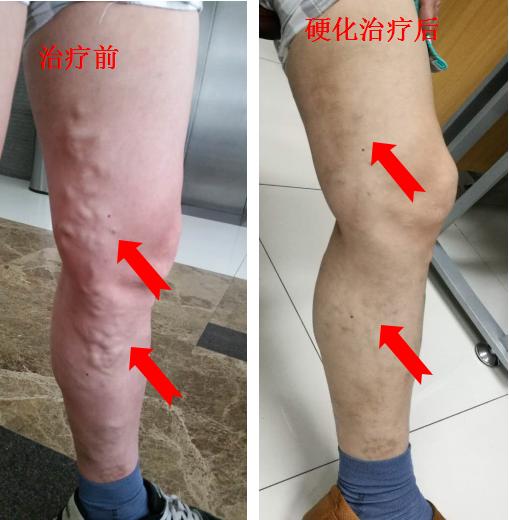 静脉曲张硬化治疗广泛应用…细针解决老难题，难看的蚯蚓腿不见了