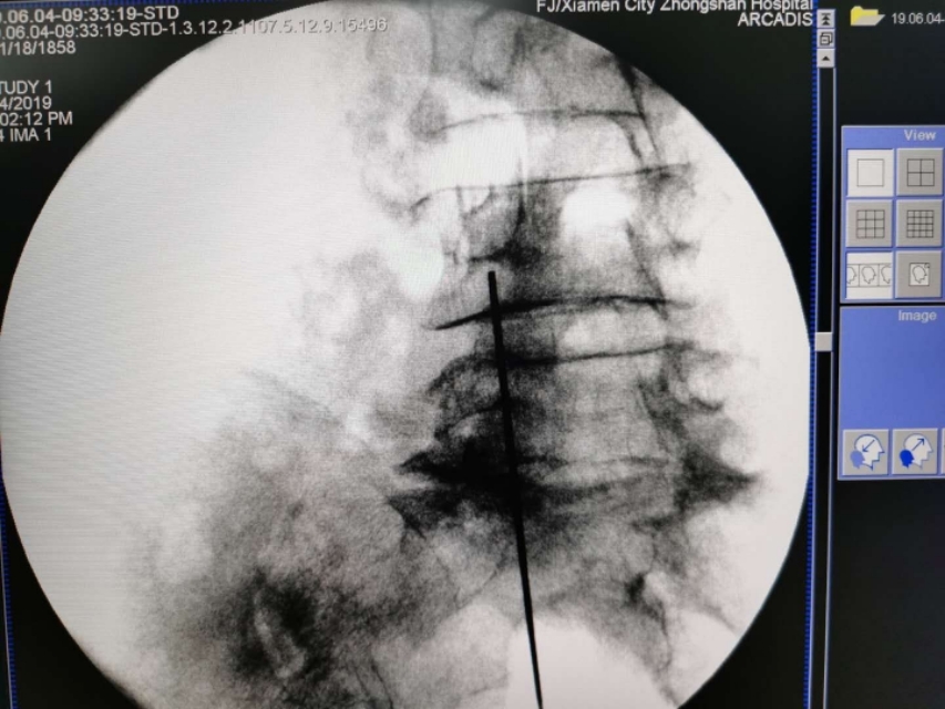 腰痛扎小针刀行吗,腰痛针灸需要吃药嘛