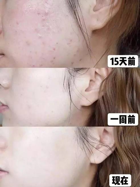 ​建议皮肤“坑洼”的女生，多在这件事花功夫，脸上净爽还更嫩了