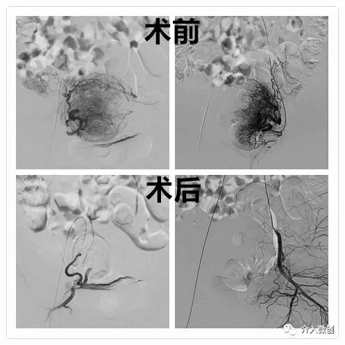 子宫肌瘤导致贫血怎么办,浆膜下子宫肌瘤会引起贫血吗