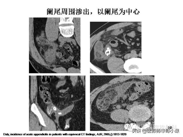 阑尾炎课件,阑尾炎的超声课件