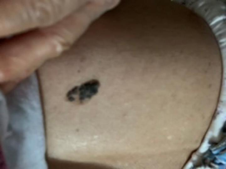 哪些部位长痣预示一生劳碌,痣的位置预示着什么